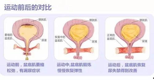 老年人盆底肌训练视频教程,老年人盆底肌训练视频教程精华概述